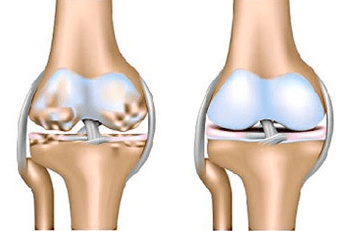 Healthy and arthrosis joint
