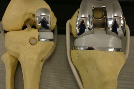 Endoprothetic variants of the knee joint