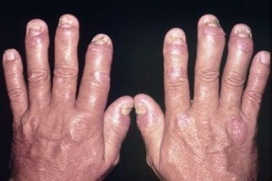 Because the joints of the fingers hurt