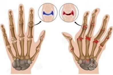 The causes of pain in the joints of the fingers