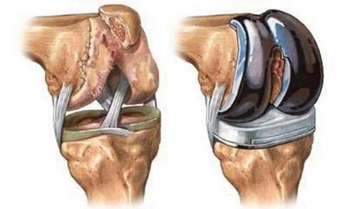 Endoprothetic of the knee joint for arthrosis