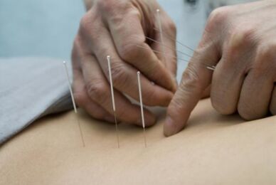 Acupuncture for osteochondrosis of the thoracic region