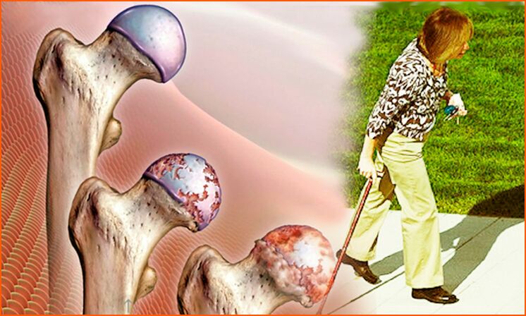 Persistent lameness in the last stage of arthrosis of the hip joint