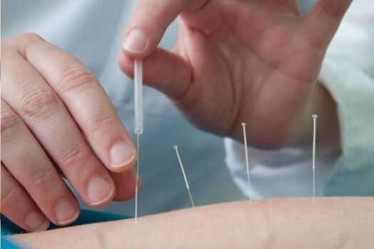Acupuncture is a method of treating pain in the lower back caused by osteochondrosis