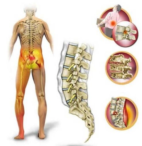 Osteochondrosis of the lumbar spine, causing lower back pain