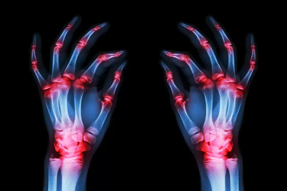 arthrosis of the finger joints