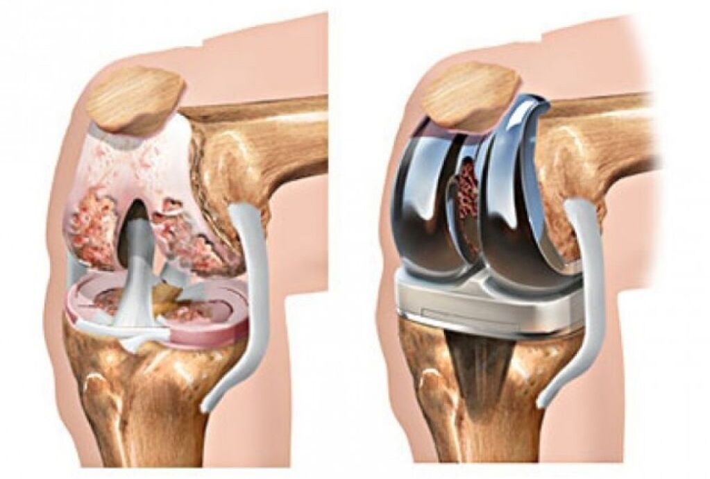 knee prosthesis for osteoarthritis