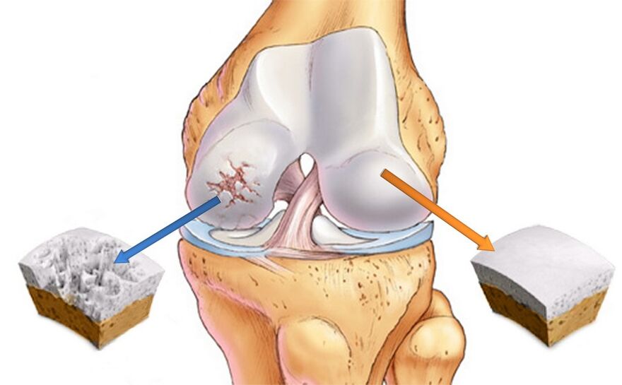 Knee healthy (right) and affected by osteoarthritis (left)