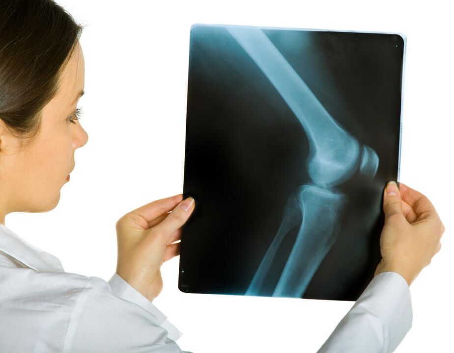 X-ray of the knee joint will reveal the presence of osteoarthritis deformans